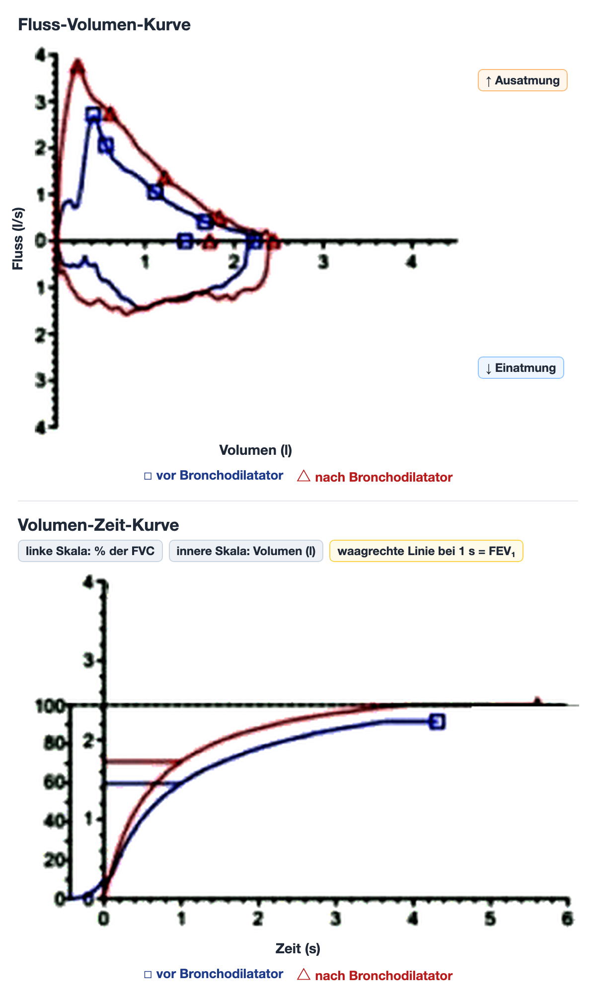 Echte Fluss-Volumen-Kurve (oben) und Volumen-Zeit-Kurve (unten) vor und nach Bronchodilatator bei einem Patienten mit COPD, deutsch beschriftet. Nach dem Bronchodilatator sind Spitzenfluss und ausgeatmetes Volumen größer, und das Volumen steigt in der ersten Sekunde steiler an.