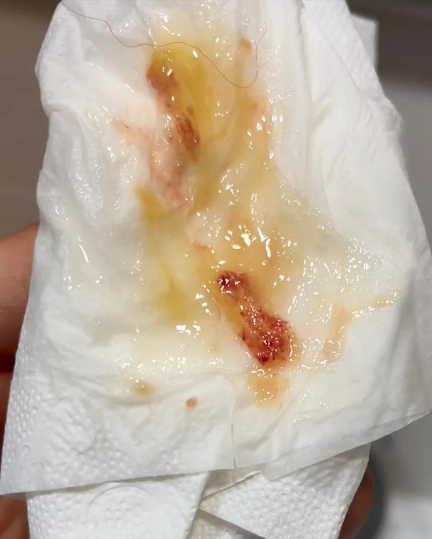 Papiertaschentuch mit gelblich-zähem Auswurf, in dem hellrote und dunkelrote Blutfäden und kleine Blutflecken liegen.