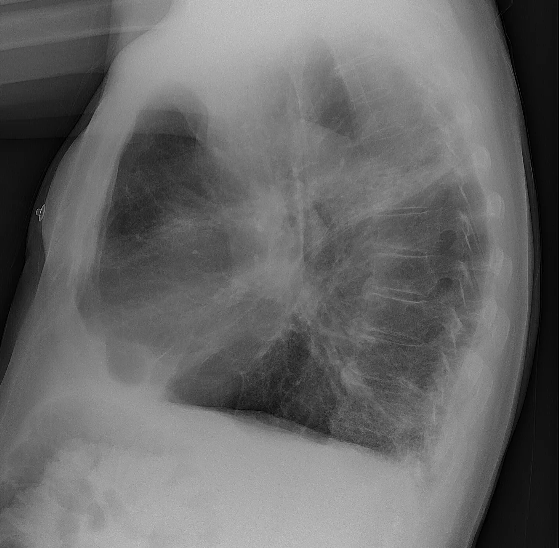Seitliche Thoraxaufnahme desselben Patienten mit großem, dunklem Raum hinter dem Brustbein und flach verlaufendem Zwerchfell.