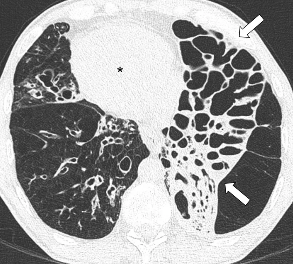 Axiale CT des unteren Thorax im Lungenfenster. Das Herz liegt auf der rechten Körperseite, im Bild links, mit Stern markiert. In beiden Unterlappen finden sich zahlreiche erweiterte, zystisch aufgetriebene Bronchien; der linke Unterlappen, im Bild rechts, ist durch Pfeile markiert und deutlich geschrumpft.