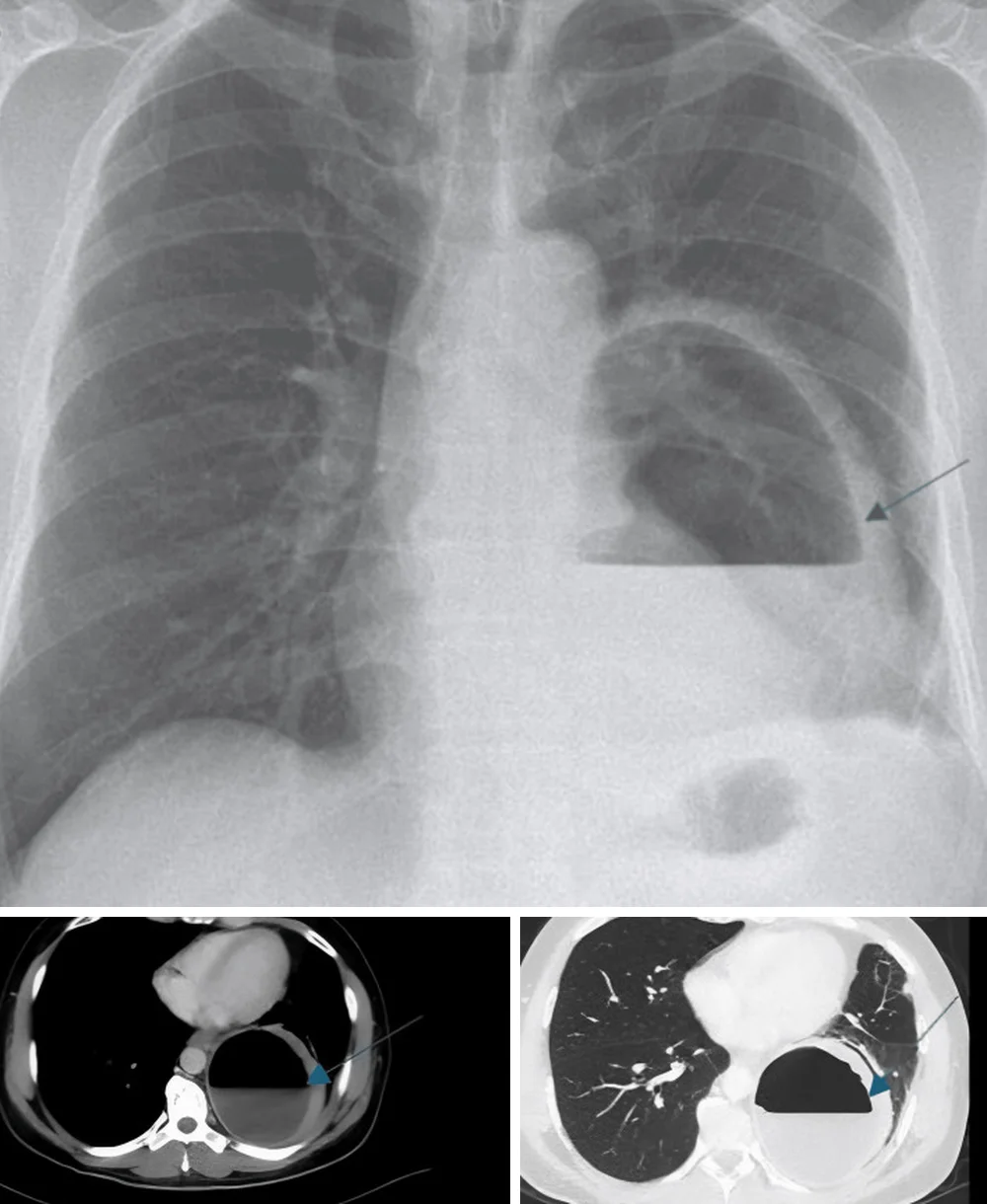 Oben Röntgen-Thorax im posterior-anterioren Strahlengang mit einer großen Höhle im linken Unterfeld und scharfem horizontalem Luft-Flüssigkeits-Spiegel, markiert durch einen Pfeil. Unten zwei CT-Schnitte desselben Patienten: links im Weichteilfenster eine runde, dickwandige Höhle im linken Unterlappen mit Flüssigkeitsspiegel, rechts im Lungenfenster dieselbe Höhle mit Luft oben und Flüssigkeit unten.