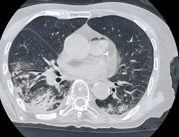 Axiale CT des Thorax im Lungenfenster mit fleckigen Konsolidierungen und verdickten Bronchialwänden in den hinteren, basalen Abschnitten beider Unterlappen, rechts ausgeprägter.