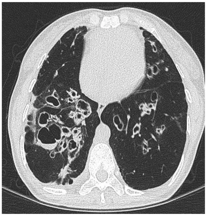 Axiale Thorax-CT im Lungenfenster: in beiden Lungen zahlreiche erweiterte, dickwandige, teils zystisch-rundliche Bronchien, rechts betont.