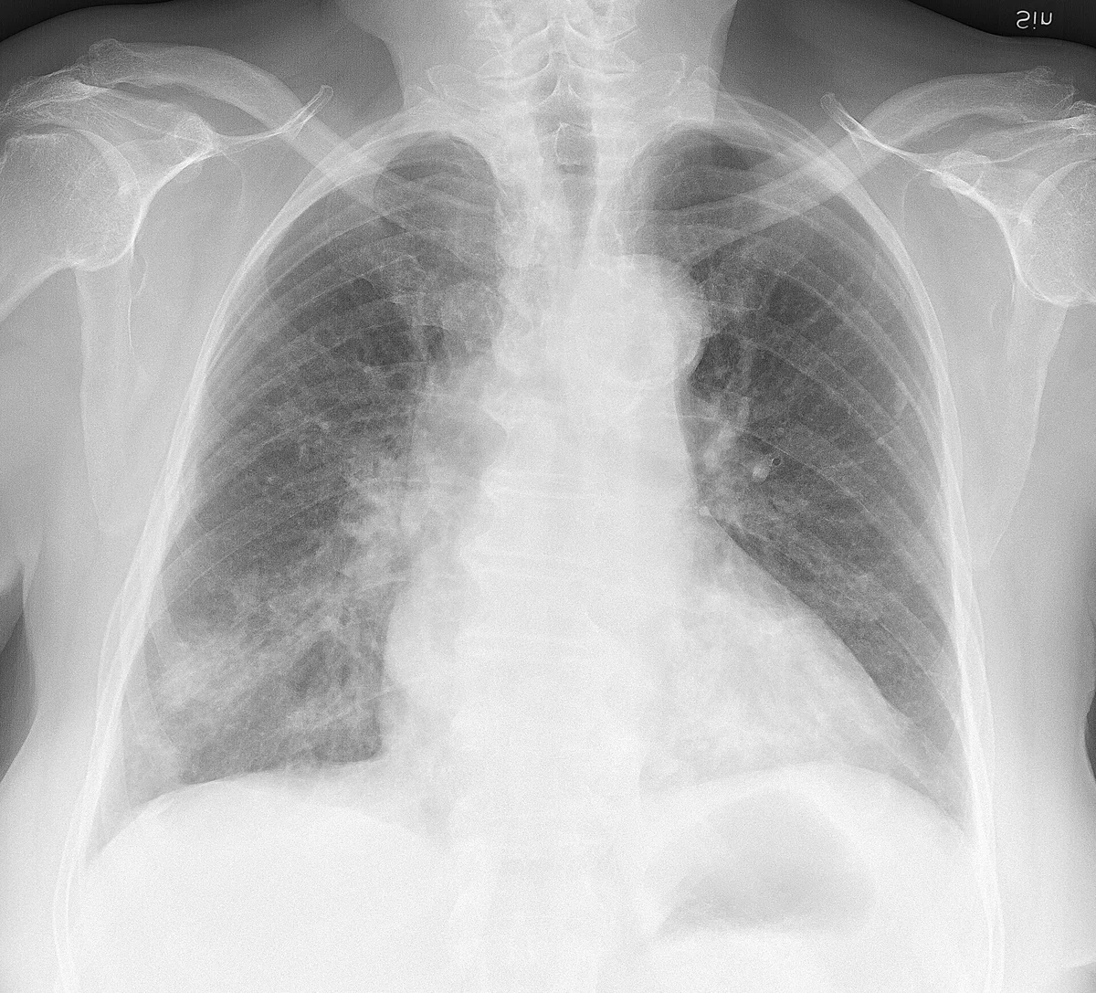 Röntgen-Thorax a.-p. einer älteren Person: beidseits fleckige und streifige Verdichtungen, rechts betont in Mittel- und Unterfeld.