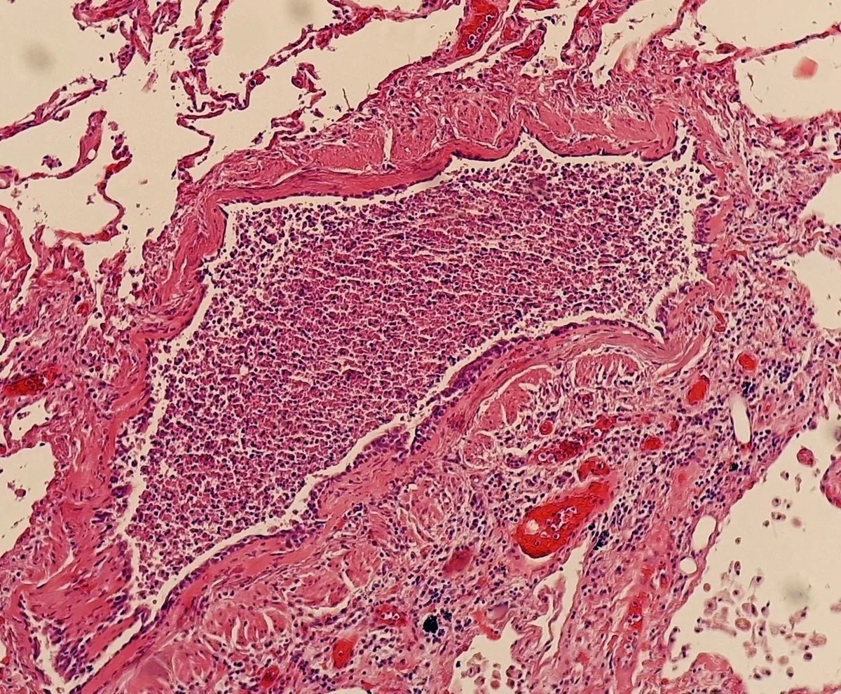 Lichtmikroskopisches Bild einer Bronchopneumonie in HE-Färbung: eine Bronchiole ist dicht mit Entzündungszellen gefüllt, am Rand liegen weiße, noch luftgefüllte Alveolen.
