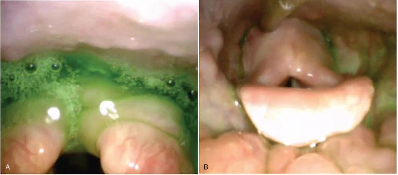 Zwei endoskopische Bilder des Kehlkopfeingangs von oben. Links liegt grün angefärbte Testflüssigkeit mit Schaumblasen in großer Menge im Rachen und über dem Kehlkopfeingang. Rechts ist der Kehlkopfeingang mit Epiglottis und Stimmritze frei, nur wenig grüne Reste am Rand.