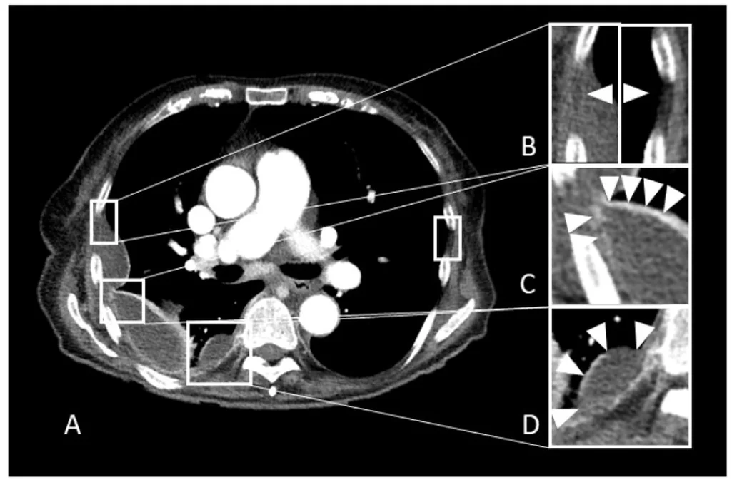 Axiale Kontrastmittel-CT des Thorax mit Erguss im rechten Pleuraspalt (A) und drei Lupenausschnitten (B bis D), in denen Pfeilspitzen auf Veränderungen von Pleura und Pleurafett zeigen.