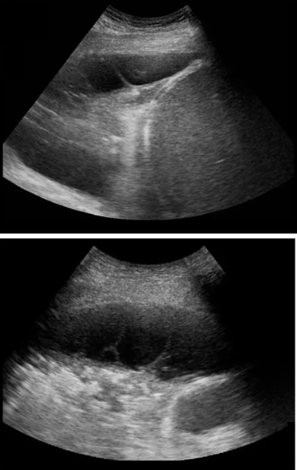 Zwei Ultraschallbilder eines Pleuraergusses über der Leber: oben ein dunkler Erguss mit hellen, fadenförmigen Septen, unten ein scharf begrenzter, abgekammerter Erguss zwischen den Pleurablättern.