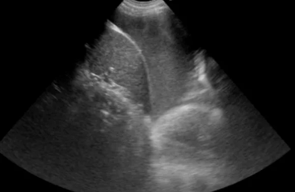 Thoraxsonografie mit Konvexschallkopf: ein großer dunkler, echofreier Raum oberhalb einer hellen, gebogenen Zwerchfelllinie; darin helleres Lungengewebe, darunter Lebergewebe.