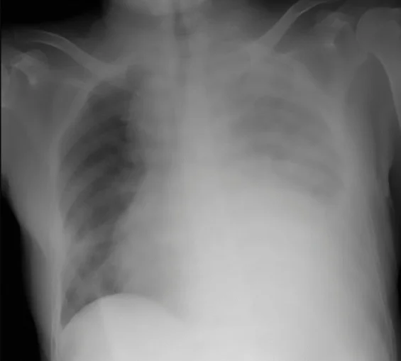 Röntgen-Thorax a.-p.: dichte, homogene Verschattung der linken Thoraxhälfte bis weit nach oben, linke Zwerchfellkontur nicht abgrenzbar; rechts belüftete Lunge.