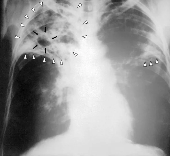 Röntgen-Thorax im anterior-posterioren Strahlengang: ausgedehnte fleckige Verschattungen im rechten Ober- und Mittelfeld, von weißen Dreiecken umrandet; darin eine rundliche Aufhellung mit Wand, auf die schwarze Pfeile zeigen. Auch links finden sich streifige Infiltrate, markiert mit weißen Dreiecken.