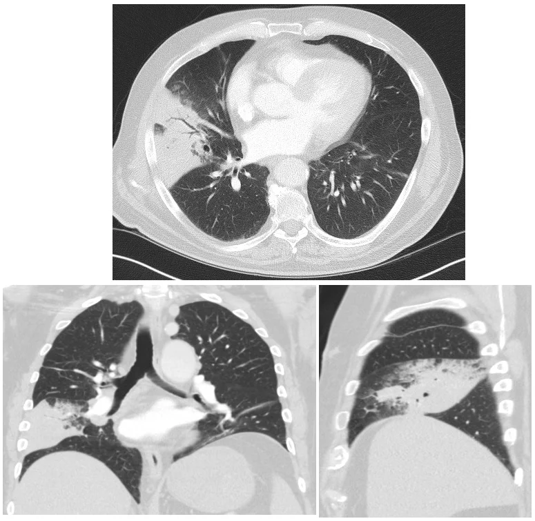 CT des Thorax in axialer, koronarer und sagittaler Ebene mit einer keilförmigen Verdichtung im rechten Mittellappen; darin verlaufen dunkle, luftgefüllte Bronchien.