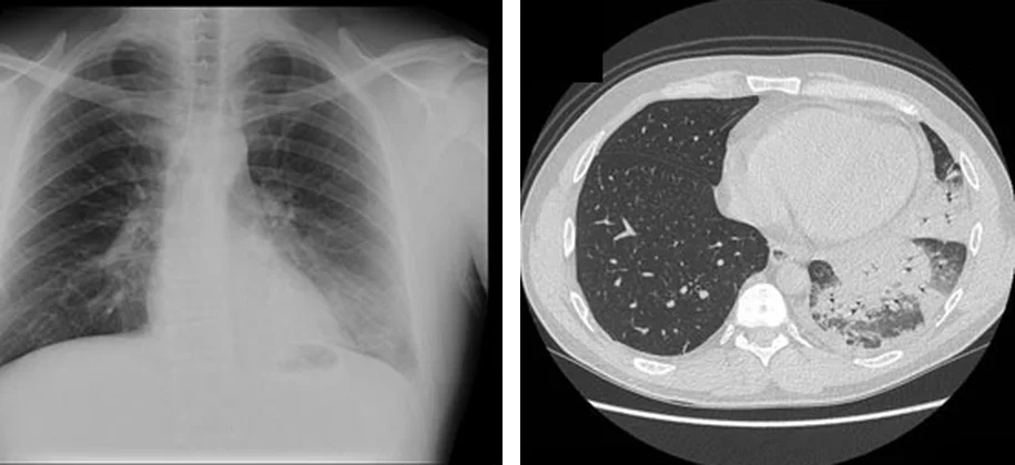 Links Röntgen-Thorax mit nur dezenter Verdichtung links basal hinter dem Herzen, rechts axiale CT derselben Person mit dichter Konsolidierung im linken Unterlappen und lufthaltigen Bronchien darin.