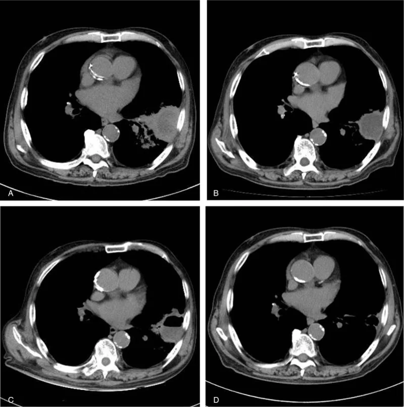 Vier axiale CT-Schnitte des Thorax im Weichteilfenster, mit A bis D bezeichnet. A: rundliche, dickwandige Raumforderung im linken Unterlappen mit flüssigkeitsdichtem Inhalt und Entzündung der Umgebung. B: Wand dünner, Umgebung ruhiger, Inhalt noch vorhanden. C: Höhle nach Entleerung des Inhalts. D: nur noch geringe Restverdichtung.