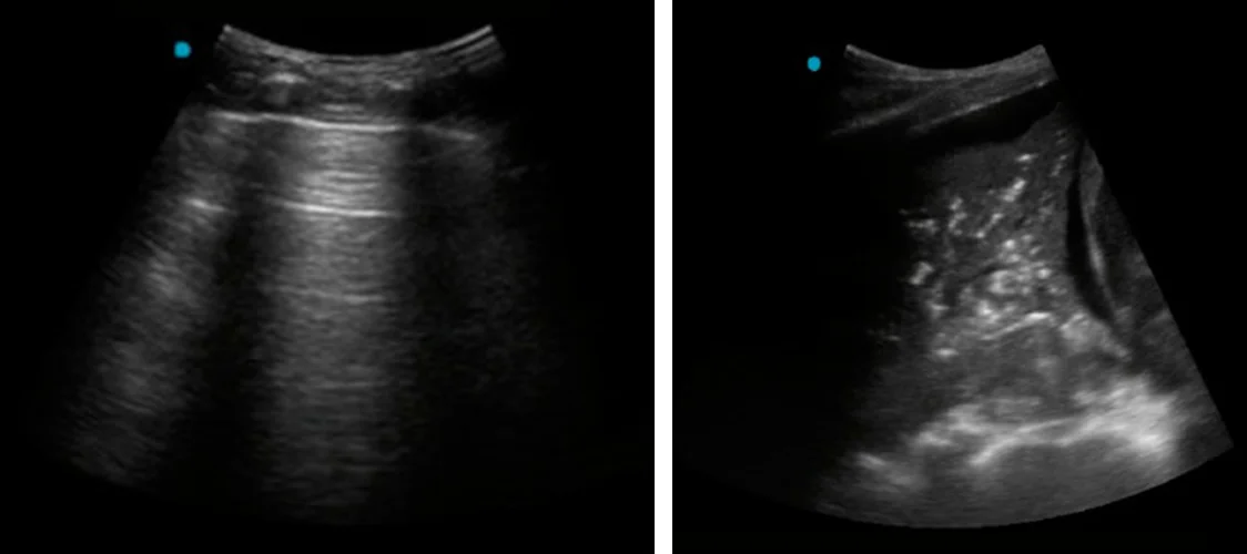 Zwei Ultraschallbilder der Lunge: links Pleuralinie mit parallelen horizontalen Wiederholungslinien, rechts gewebeähnlich echoreiche Lunge mit hellen punktförmigen Luftreflexen.