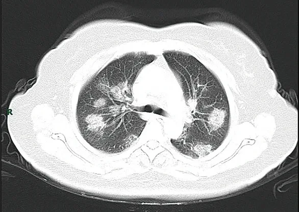 Axiales CT des Thorax im Lungenfenster auf Höhe der Oberlappen: in beiden Lungen mehrere rundliche, unscharf begrenzte Milchglasherde, teils peripher, teils peribronchovaskulär; Gefäße bleiben innerhalb der Herde sichtbar. Rechts im Bild ein Seitenbuchstabe R.