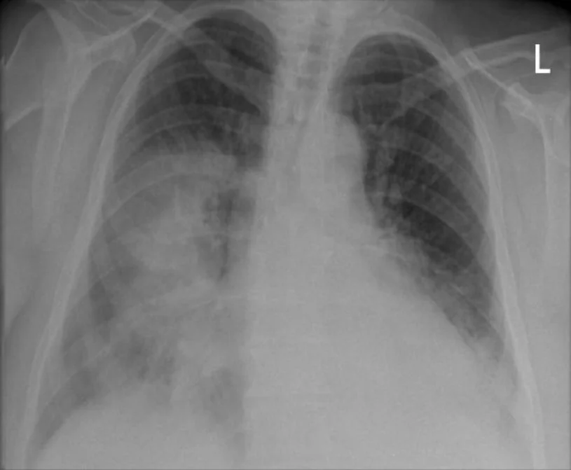Röntgen-Thorax im posterior-anterioren Strahlengang mit fleckigen bis flächigen Verdichtungen im rechten Mittelfeld und in beiden Unterfeldern; die linke Lungenspitze und das linke Oberfeld sind frei.