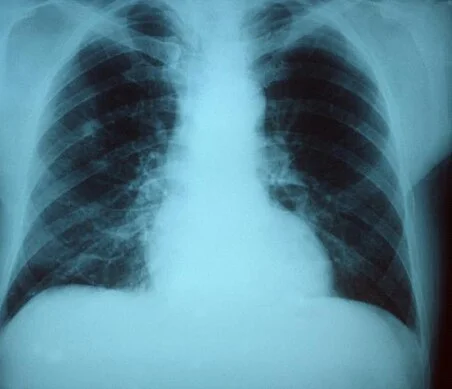 Röntgen-Thorax im anterior-posterioren Strahlengang: fleckige, unscharf begrenzte Verschattung in der rechten Lunge, vor allem im Oberfeld; die linke Lunge ist belüftet.