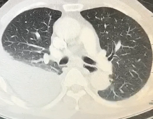 Axiale Thorax-CT auf Höhe der Hauptbronchien: rechts dorsal eine große, homogene, sichelförmige Flüssigkeitsansammlung, die die angrenzende Lunge zusammendrückt; links unauffällige Lunge.