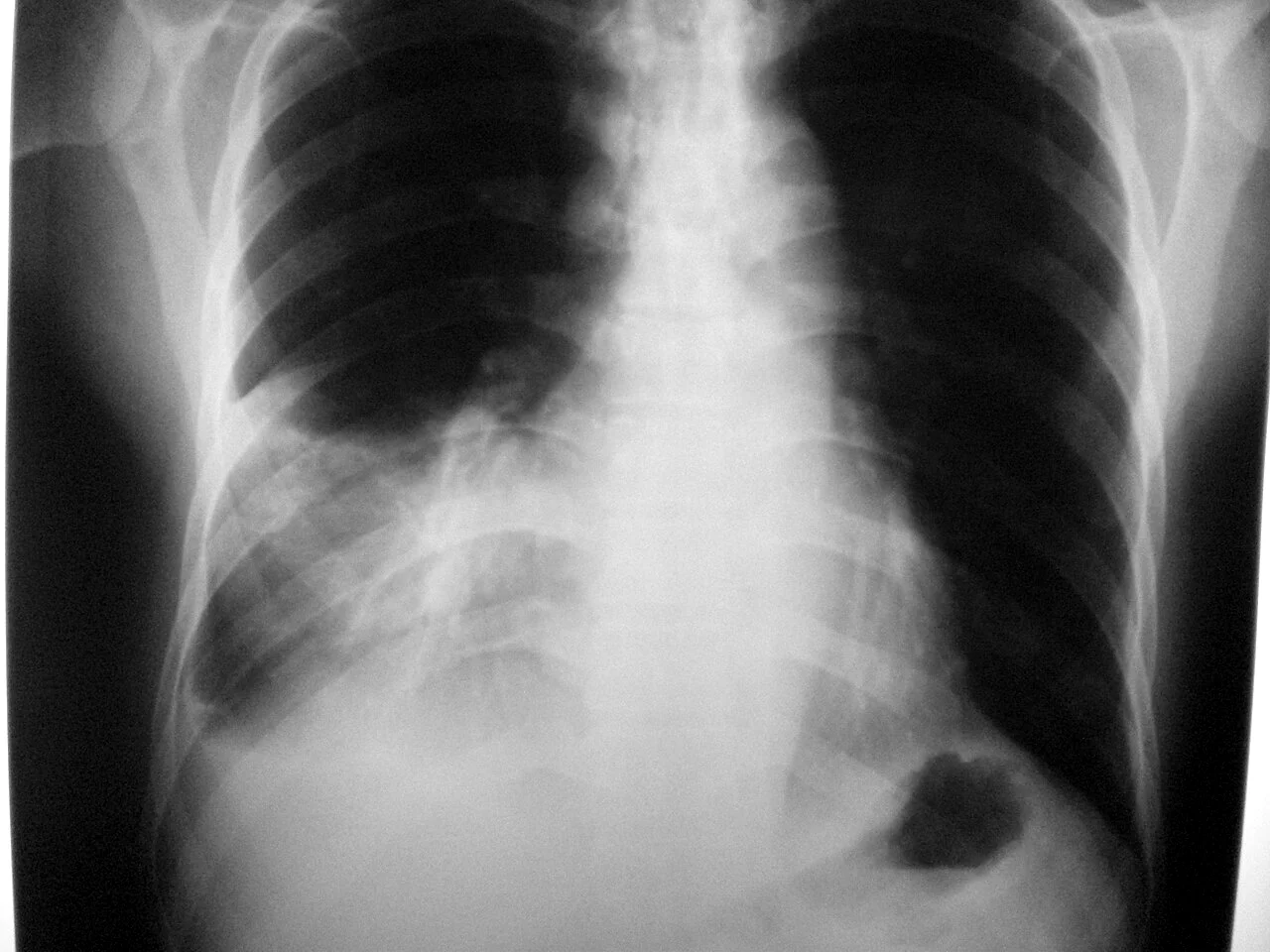 Röntgen-Thorax im posterior-anterioren Strahlengang: flächige Verschattung im rechten Unterfeld mit unscharfer Begrenzung, rechte Zwerchfellkontur teilweise nicht abgrenzbar, linke Lunge frei.