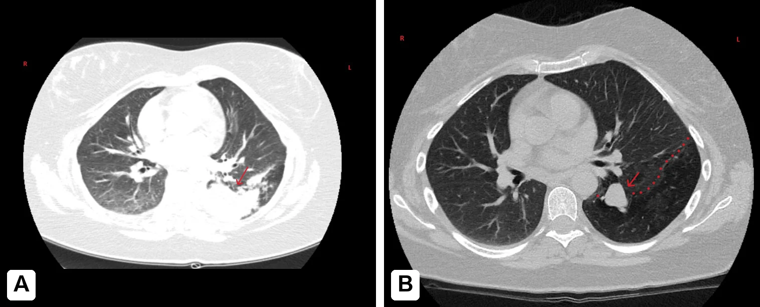Zwei axiale CT-Schnitte desselben Patienten im Lungenfenster. Links eine dichte Konsolidierung im linken Unterlappen mit luftgefüllten Bronchien. Rechts drei Wochen später ist die Konsolidierung verschwunden; neben dem linken Hilus liegt eine rundliche, fingerförmige Verdichtung, das umgebende Lungengewebe ist dunkler und luftreicher.