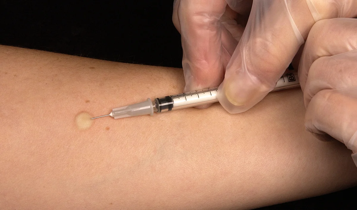 Foto eines Unterarms: Eine behandschuhte Hand hält eine dünne Tuberkulinspritze fast parallel zur Haut; die Nadelspitze liegt intrakutan, an der Einstichstelle hat sich eine kleine, blasse, erhabene Quaddel gebildet.