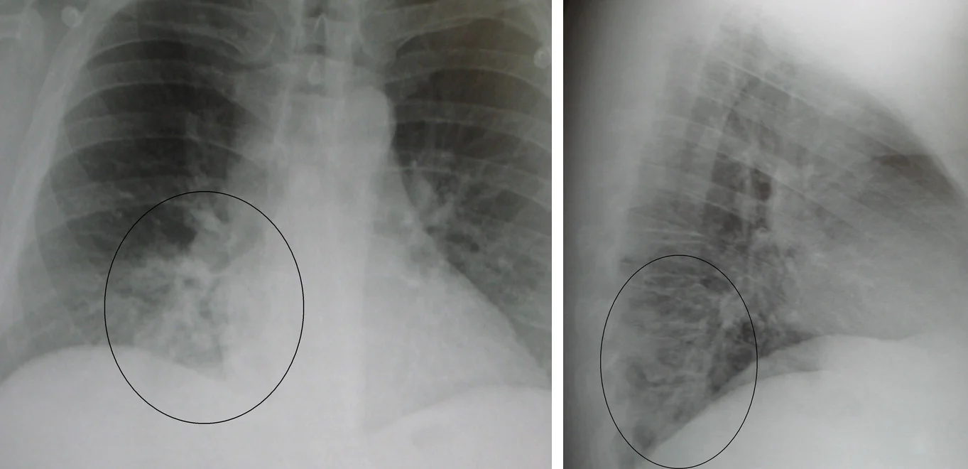 Röntgen-Thorax a.-p. und seitlich; ein Kreis markiert eine fleckige Verdichtung rechts basal, in der Seitaufnahme hinten unten über dem Zwerchfell.