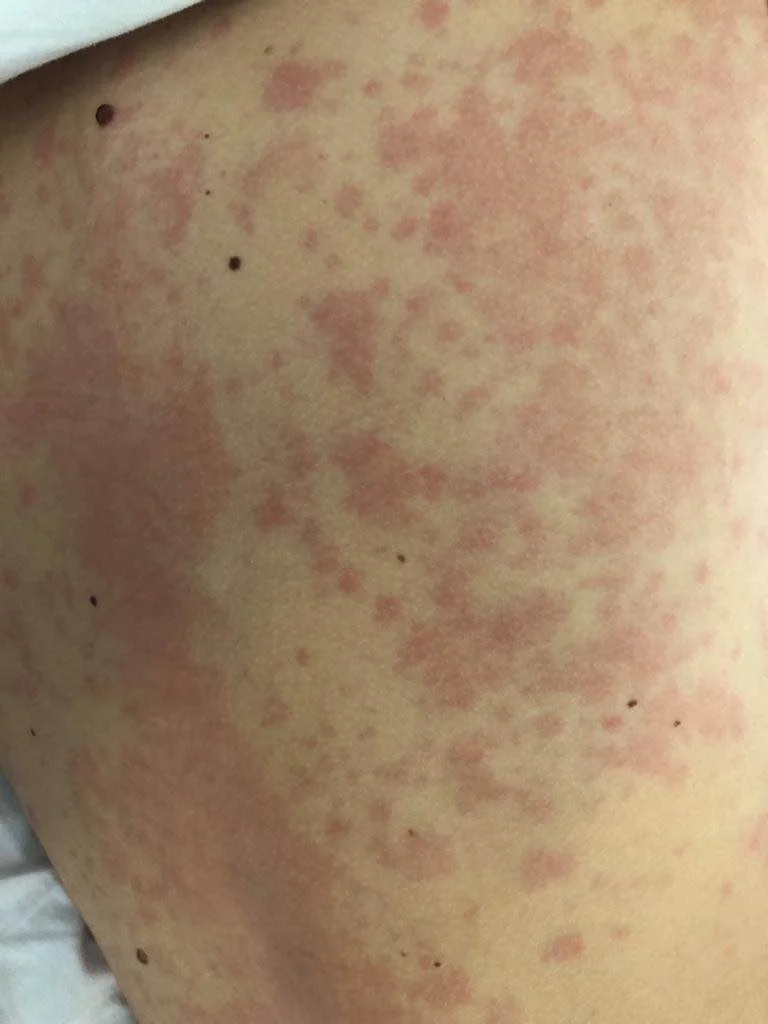 Fotografie der Haut: zahlreiche blassrote, erhabene, teils zusammenfließende Quaddeln über einer größeren Hautfläche.