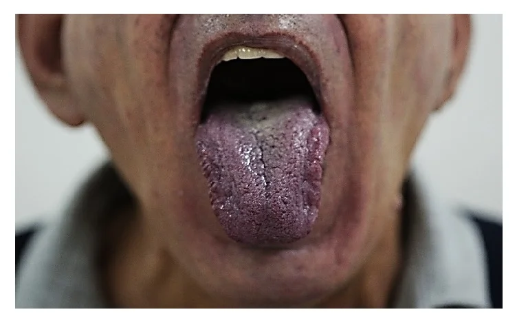 Untere Gesichtshälfte eines Mannes mit herausgestreckter Zunge: Zunge und Lippen sind deutlich bläulich-violett verfärbt.