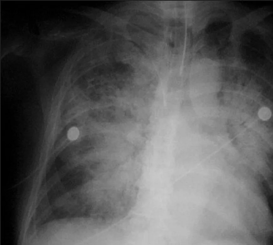 Frontale Thoraxaufnahme eines Intensivpatienten mit EKG-Elektroden und Kathetern: beidseits fleckige, zusammenfließende Verdichtungen, die sich von den Lungenhili fächerförmig nach außen ausbreiten; die Lungenperipherie ist teilweise noch belüftet.