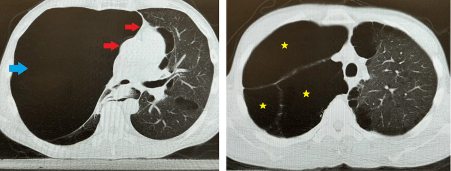 CT-Thorax axial im Lungenfenster: rechts sehr große luftgefüllte Räume mit Verlagerung des Mediastinums nach links; im zweiten Schnitt mehrere große Bullae, getrennt durch dünne Septen.