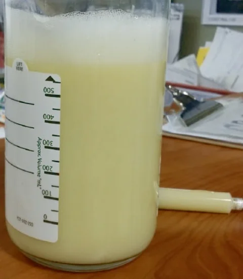 Glasgefäß mit Volumenskala, gefüllt mit undurchsichtiger, milchig-gelblicher Pleuraflüssigkeit und Schaum an der Oberfläche.