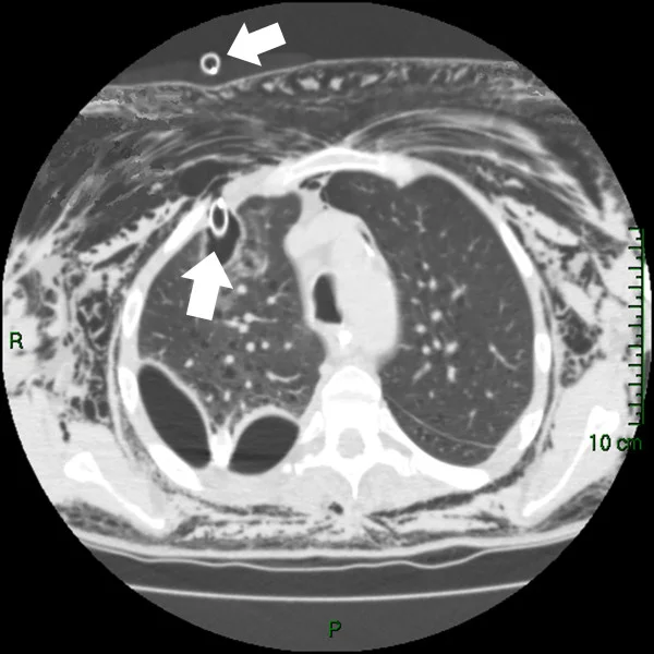 Axiales Thorax-CT im Lungenfenster: Ein Drainageschlauch (Pfeile) liegt im rechten Oberlappen; ausgedehnte Luft in den Weichteilen der Brustwand.