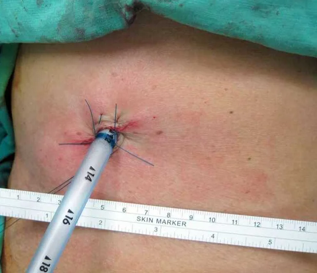 Seitliche Brustwand mit einer frisch eingelegten Thoraxdrainage; am Hautaustritt mehrere blaue Nähte, auf dem Schlauch Zahlenmarkierungen, darunter ein Lineal mit Zentimeterskala.