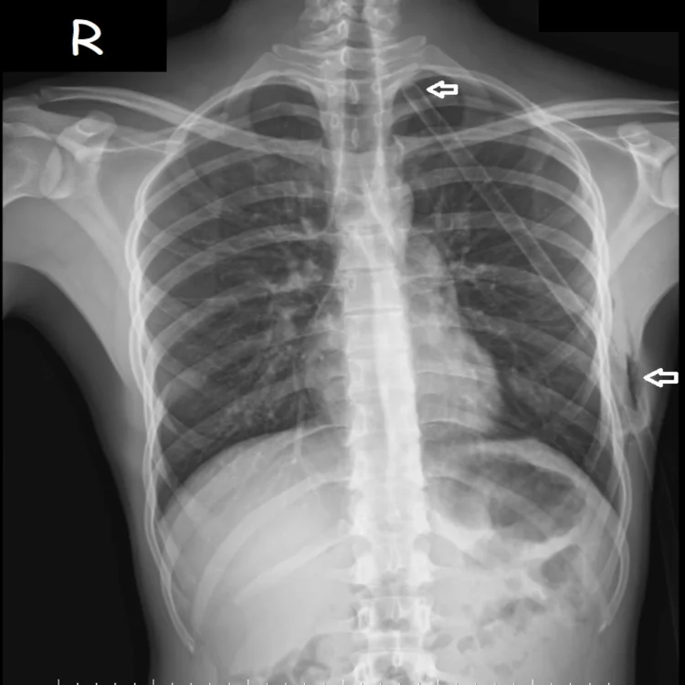 Röntgen-Thorax p.a. mit einer Drainage links: Eintrittsstelle an der seitlichen Brustwand, Verlauf nach oben bis in die Lungenspitze; beide Lungen sind bis zur Brustwand belüftet.