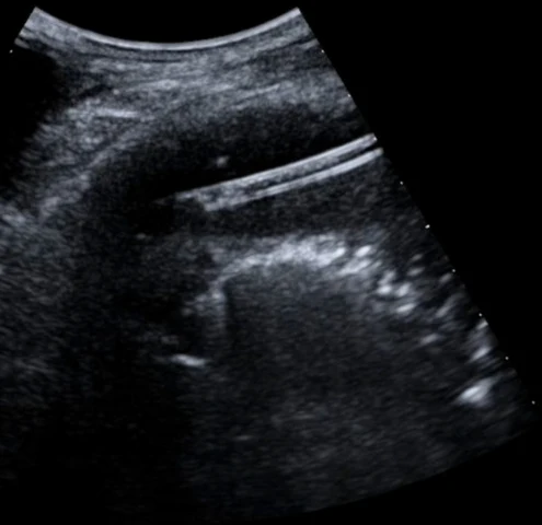Thoraxsonografie mit einer hellen, schräg verlaufenden Doppellinie im Pleuraraum, umgeben von echoarmer Restflüssigkeit.