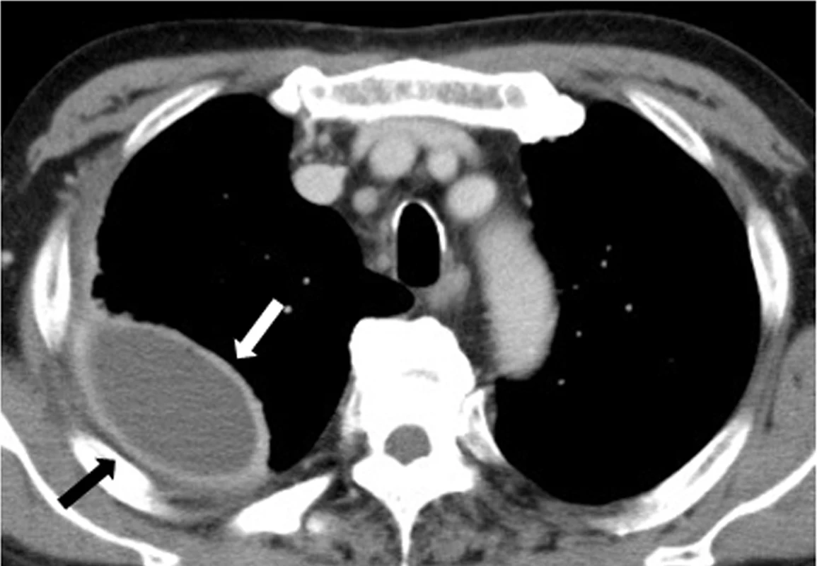 Axiales Thorax-CT mit Kontrastmittel: rechts dorsal eine linsenförmige, gekammerte Flüssigkeitsansammlung; die viszerale Pleura (weißer Pfeil) und die parietale Pleura (schwarzer Pfeil) sind verdickt und auseinandergedrängt.