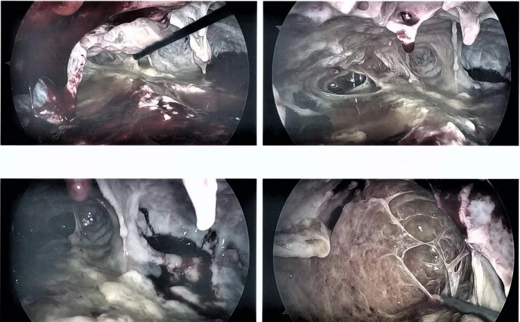 Vier thorakoskopische Ansichten eines infizierten Pleuraraums mit gelblich-weißem Eiter, Fibrinbelägen und strangförmigen Verwachsungen zwischen Lunge und Brustwand.