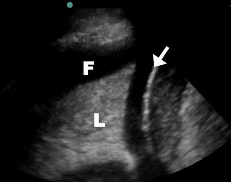 Thoraxsonografie mit Konvexsonde oberhalb des Zwerchfells: dunkler, echofreier Flüssigkeitssaum (F) über verdichtetem Lungengewebe (L); ein Pfeil zeigt auf die helle Zwerchfelllinie.