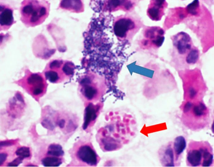 Mikroskopisches Bild eines Pleurapunktats nach Gram-Färbung bei starker Vergrößerung: dicht gelagerte Neutrophile, ein Haufen kleiner dunkelvioletter Kokken (blauer Pfeil) und eine Zelle mit zahlreichen roten Stäbchen (roter Pfeil).