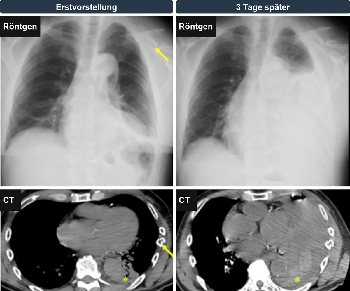 Links Röntgen-Thorax und CT bei Erstvorstellung nach Fahrradsturz: Rippenfrakturen links, Klavikulafraktur (Pfeil) und kleiner dorsaler Erguss (Stern). Rechts dieselbe Person drei Tage später: linker Hemithorax fast vollständig verschattet, im CT großer hyperdenser Erguss mit komprimierter linker Lunge.