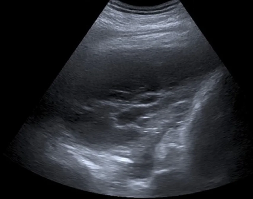 Thoraxsonografie mit Konvexsonde: unter der Brustwand ein großer Pleuraerguss mit uneinheitlichen, teils echoreichen Binnenstrukturen und Septen; in der Tiefe komprimiertes Lungengewebe.