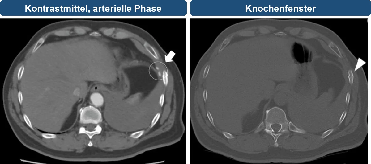 Zwei axiale CT-Schnitte auf Höhe des Oberbauchs: links in der arteriellen Kontrastmittelphase ein heller Kontrastmittelaustritt (Kreis, Pfeil) an der linken seitlichen Brustwand neben einem linksseitigen Erguss; rechts im Knochenfenster die zugehörige Rippenfraktur (Pfeilspitze).