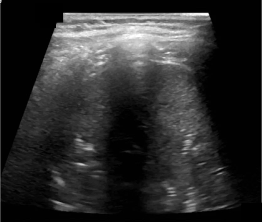 Lungensonografie, Schallkopf oben: unter der Thoraxwand ein gewebeartig echoarmer Lungenabschnitt mit vielen kleinen punktförmigen hellen Reflexen.