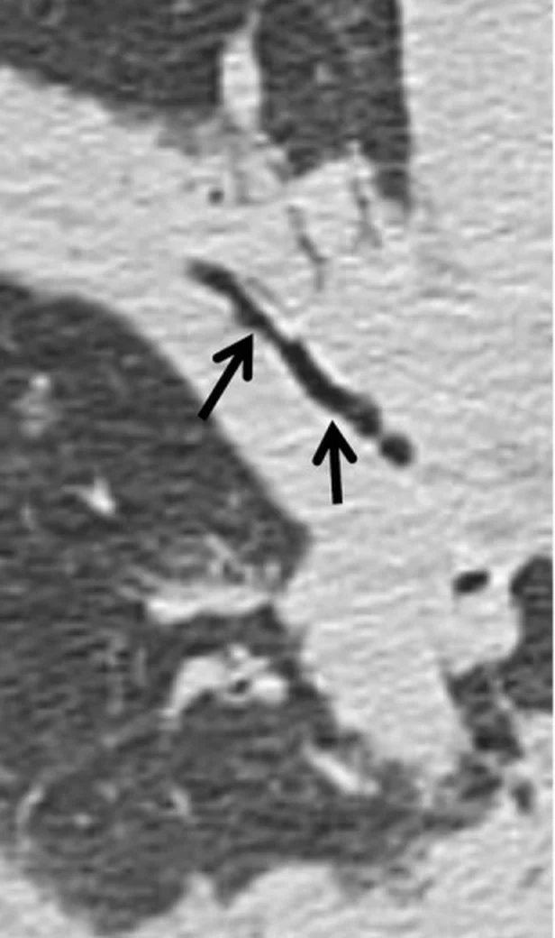 CT-Ausschnitt: helle, dichte Lungenverdichtung, in der ein dunkler, luftgefüllter Bronchus mit zwei schwarzen Pfeilen markiert ist; daneben normal belüftete Lunge.