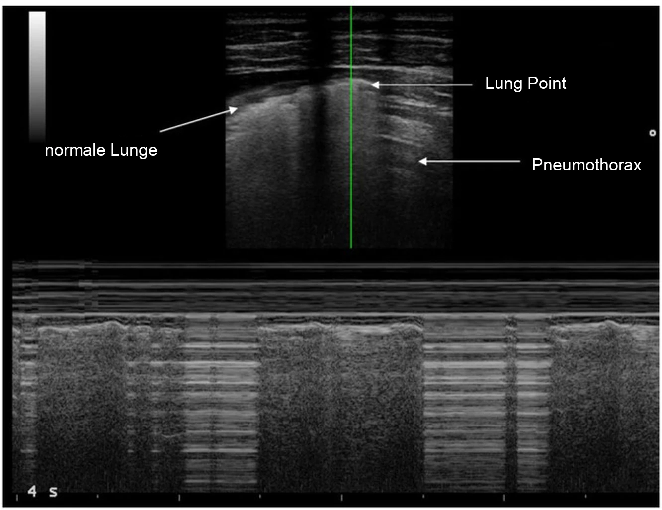 Thoraxsonografie mit M-Mode: oben B-Bild mit markiertem Übergang zwischen normaler Lunge und Pneumothorax; unten wechseln körnige Abschnitte mit Abschnitten aus horizontalen Linien.
