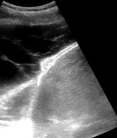Thoraxsonografie: Oberhalb der hellen Zwerchfelllinie liegt ein dunkler, flüssigkeitsgefüllter Raum, der von feinen hellen Strängen durchzogen und in Abschnitte unterteilt wird.