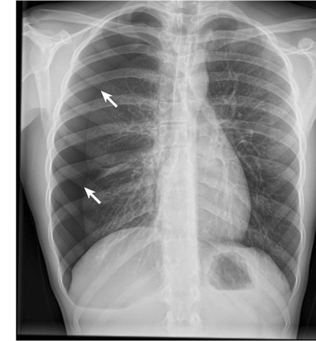 Röntgen-Thorax p.a. eines 18-Jährigen: rechts zwei Pfeile auf einer feinen Linie parallel zur Thoraxwand; lateral davon keine Lungengefäßzeichnung.
