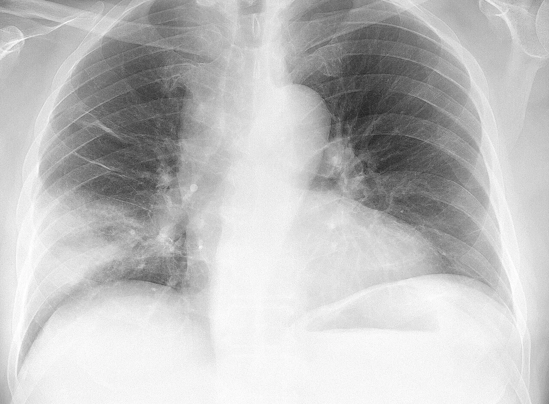Frontale Thoraxaufnahme eines Mannes: im rechten Mittelfeld eine dichte, fleckig-homogene Verdichtung, die nach oben relativ scharf begrenzt ist; medial davon und in der linken Lunge normal belüftetes Lungengewebe.
