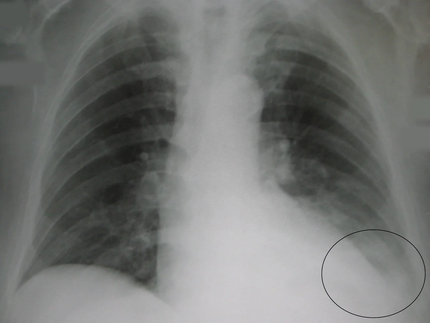 Röntgen-Thorax im Stehen: links basal eine unscharfe Verschattung im Unterfeld; der seitliche Zwerchfell-Rippen-Winkel links ist verschattet und abgerundet und mit einem Kreis markiert. Die rechte Lunge ist frei.